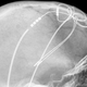 An x-ray image of someone who had electrodes implanted into their brain to manage their Parkinson’s disease.